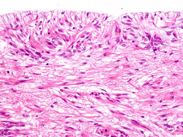 1C9 Angiocentric Glioma (Case 1) H&E 15