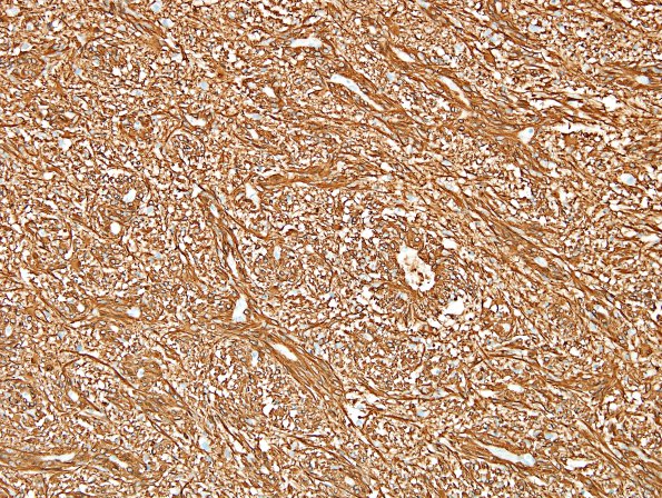 1D2 Angiocentric Glioma (Case 1) GFAP 1