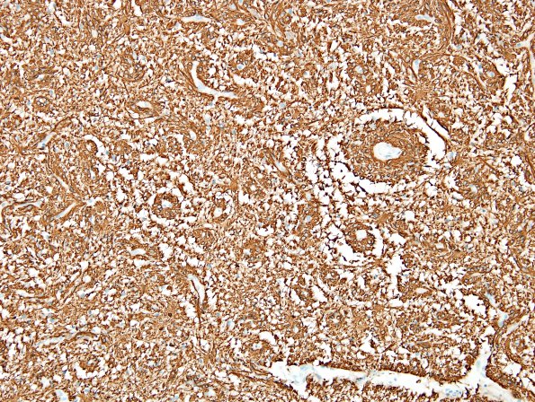 1D3 Angiocentric Glioma (Case 1) GFAP 3