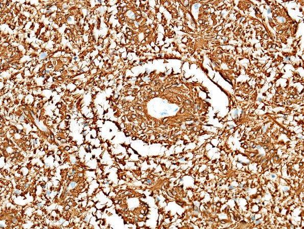 1D4 Angiocentric Glioma (Case 1) GFAP 2.