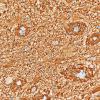 1D5 Angiocentric Glioma (Case 1) GFAP 40X3