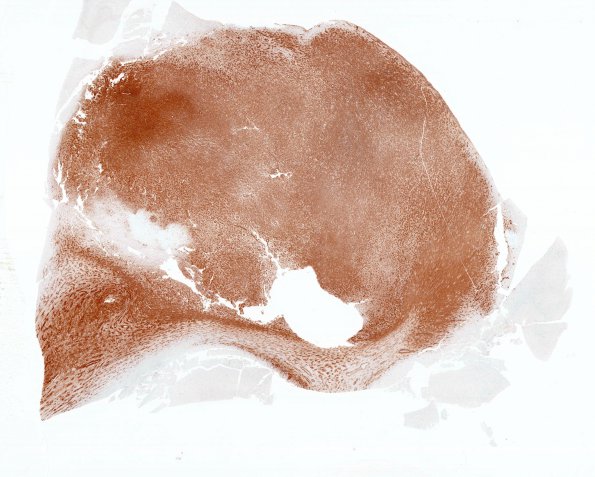 1E1 Angiocentric Glioma (Case 1) D2-40 whole mount