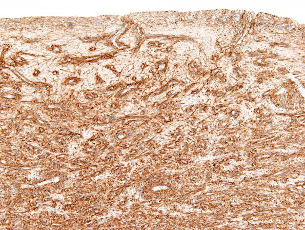 1E2 Angiocentric Glioma (Case 1) D2-40 1