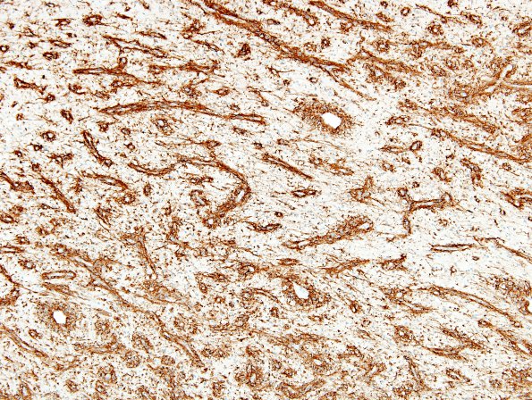 1E4 Angiocentric Glioma (Case 1) D2-40 4