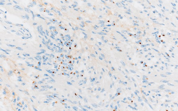 1F Angiocentric Glioma (Case 1) EMA 1