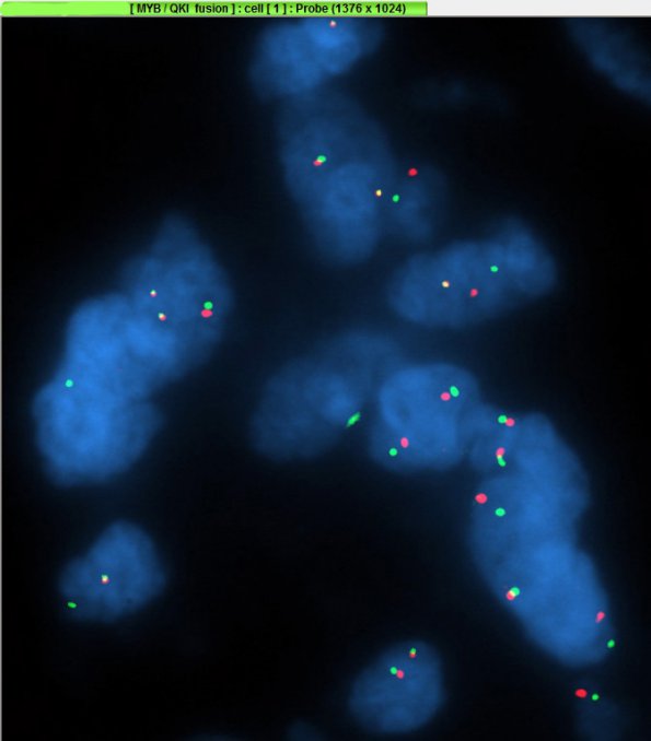 1G1 Angiocentric Glioma (Case 1) MYB-QKI_1 - Copy