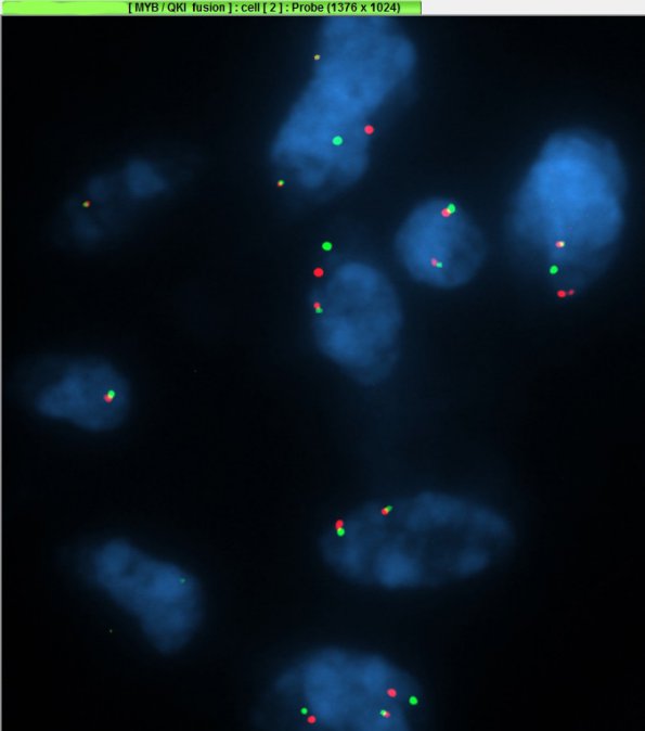 1G2 Angiocentric Glioma (Case 1) MYB-QKI_2 - Copy