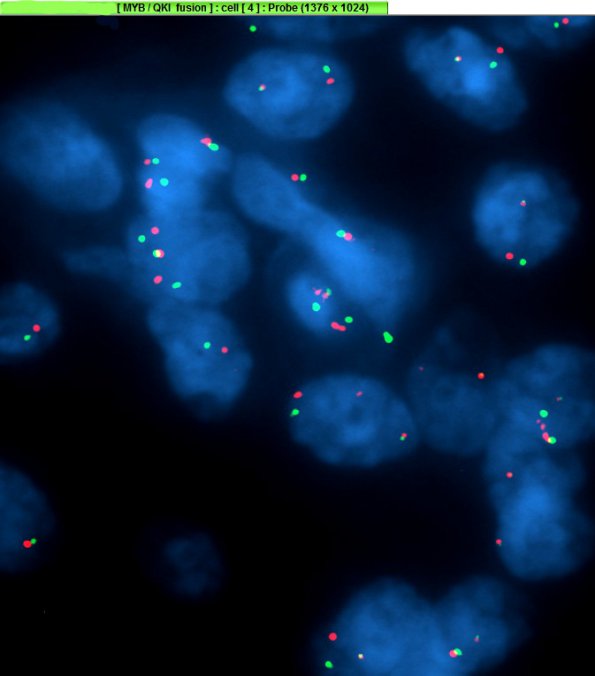 1G3 Angiocentric Glioma (Case 1) MYB-QKI_4 - Copy