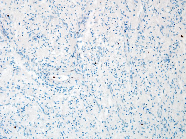 1H Angiocentric Glioma (Case 1) Ki67