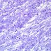 1I1 Angiocentric glioma (Case 1) Plastic 5