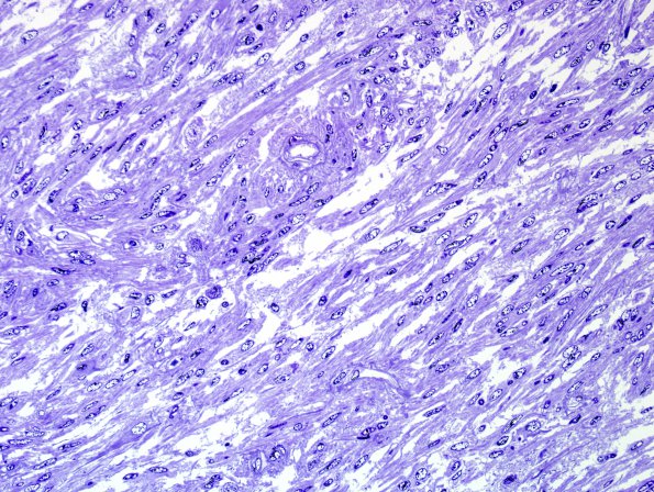 1I1 Angiocentric glioma (Case 1) Plastic 5