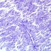 1I2 Angiocentric glioma (Case 1) Plastic 6