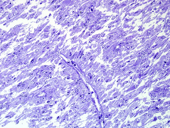 1I2 Angiocentric glioma (Case 1) Plastic 6