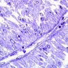 1I3 Angiocentric glioma (Case 1) Plastic 9