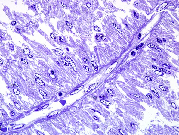 1I3 Angiocentric glioma (Case 1) Plastic 9