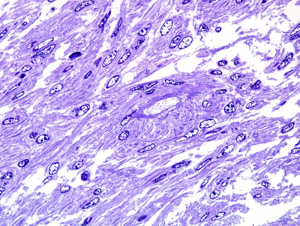 1I4 Angiocentric glioma (Case 1) Plastic 8