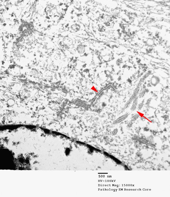 1J1 Angiocentric Glioma (Case 1) EM 030 copy - Copy