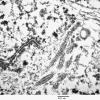 1J2 Angiocentric Glioma (Case 1) EM 032 - Copy