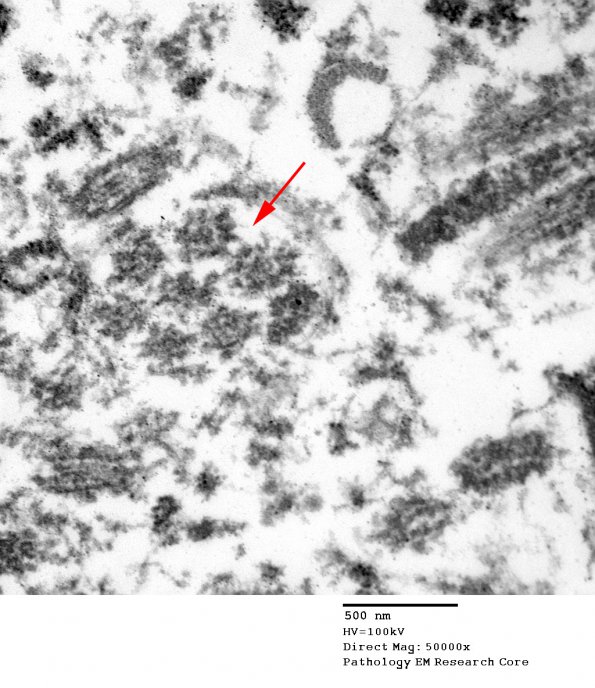 1J5 Angiocentric Glioma (Case 1) EM 054 copy - Copy