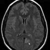 2A1 Angiocentric Glioma (Case 2) FLAIR 1 copy