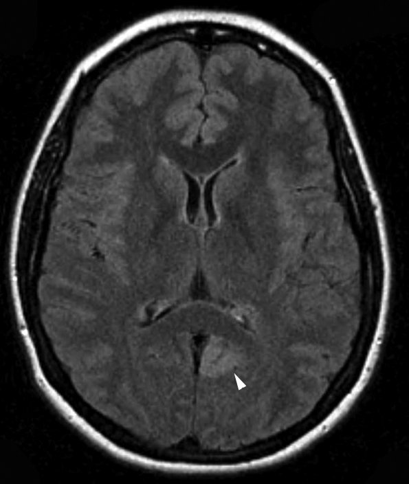 2A1 Angiocentric Glioma (Case 2) FLAIR 1 copy