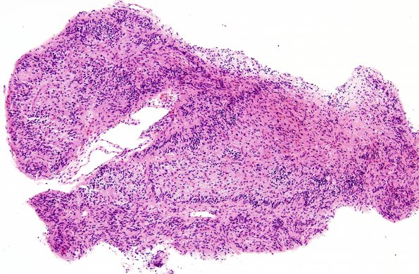 2B1 Angiocentric Glioma (Case 2) H&E 6