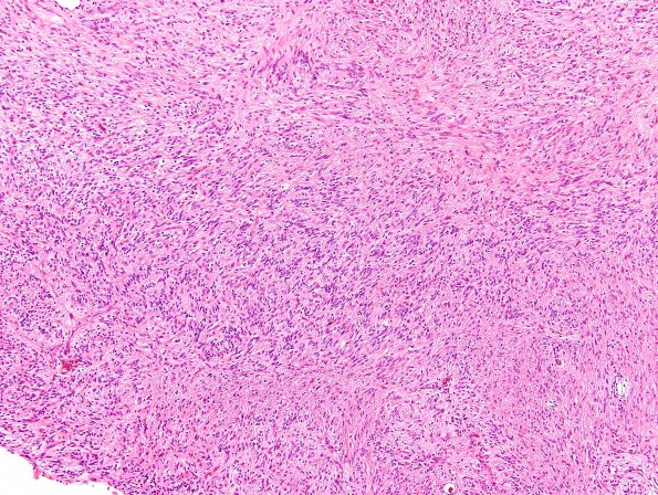 2B2 Angiocentric Glioma (Case 2) H&E 8