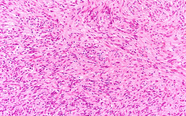 2B3 Angiocentric Glioma (Case 2) H&E 2