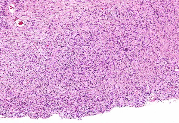 2B4 Angiocentric Glioma (Case 2) H&E 5