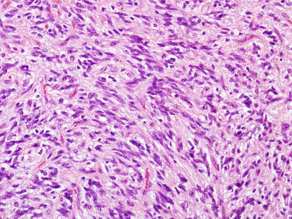 2B5 Angiocentric Glioma (Case 2) H&E 2