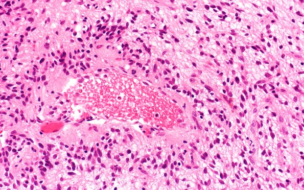 2B6 Angiocentric Glioma (Case 2) H&E 1