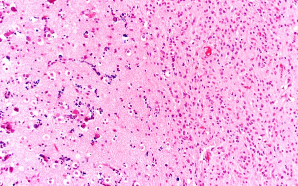 2B7 Angiocentric Glioma (Case 2) H&E 2