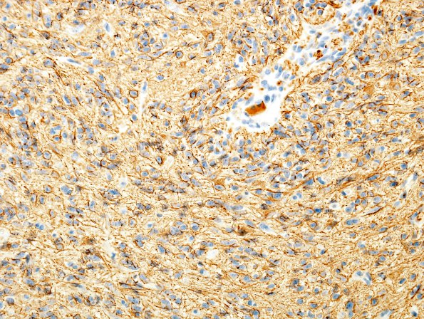 2C1 Angiocentric Glioma (Case 2) GFAP 1