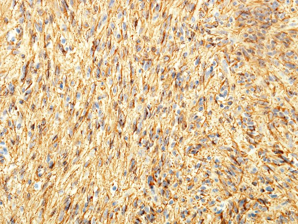 2C2 Angiocentric Glioma (Case 2) GFAP 2