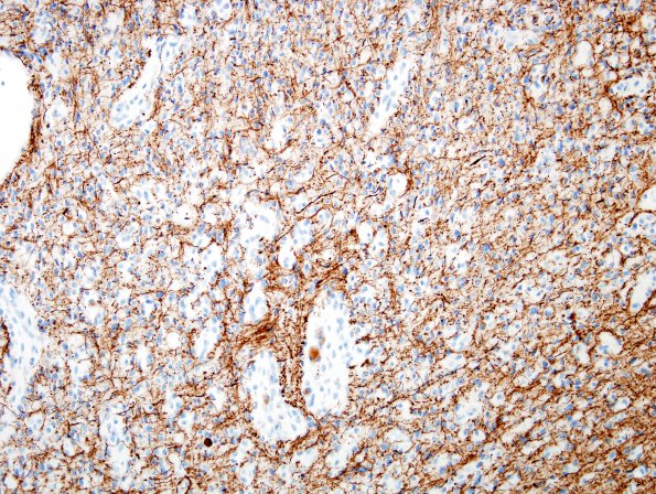 2D2 Angiocentric Glioma (Case 2) NF 1