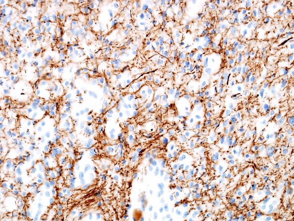 2D3 Angiocentric Glioma (Case 2) NF 2