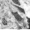 2E2 Angiocentric Glioma (Case 2 5 - Copy