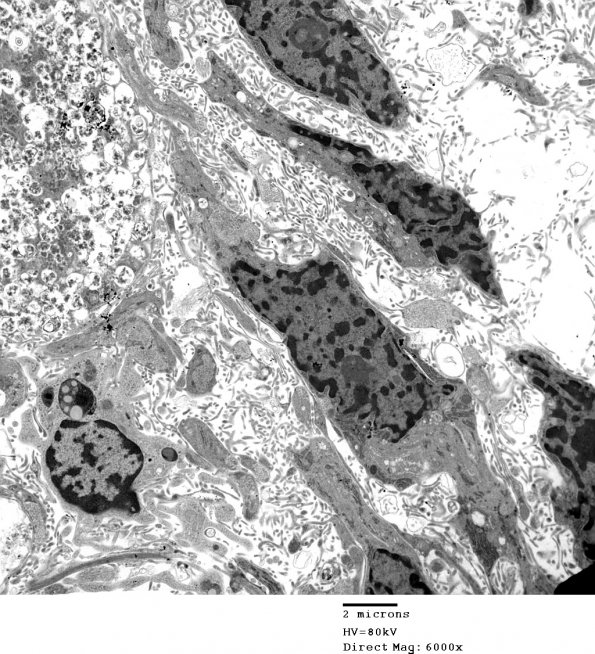 2E2 Angiocentric Glioma (Case 2 5 - Copy