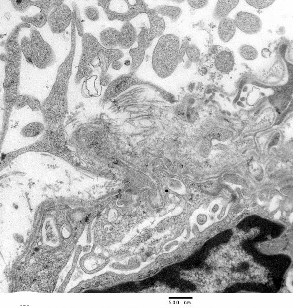 2E3 Angiocentric Glioma (Case 2) 12 - Copy