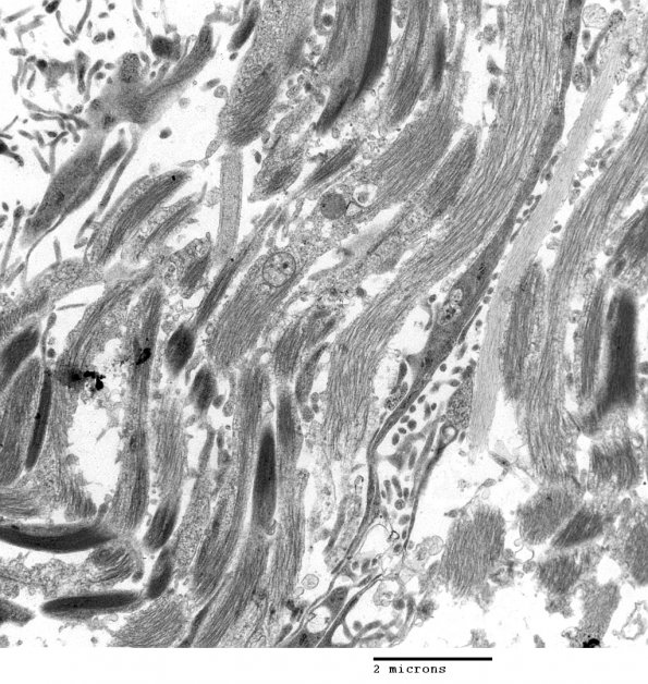 2E4 Angiocentric Glioma (Case 2) 14 - Copy