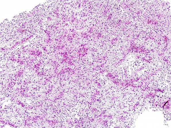 3A1 Angiocentric Glioma (Case 3) H&E 4