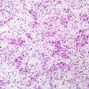 3A2 Angiocentric Glioma (Case 3) H&E 3