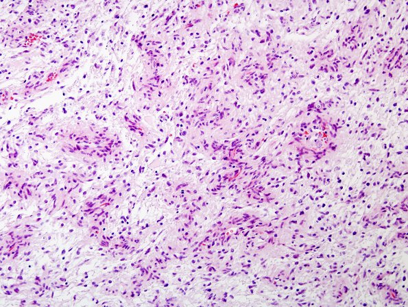 3A2 Angiocentric Glioma (Case 3) H&E 3