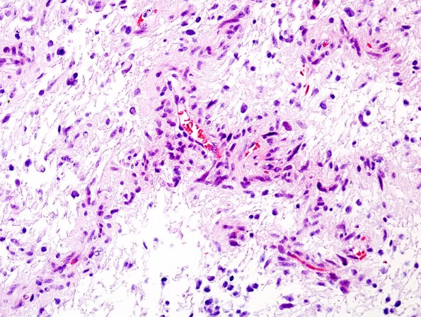 3A3 Angiocentric Glioma (Case 3) H&E 1