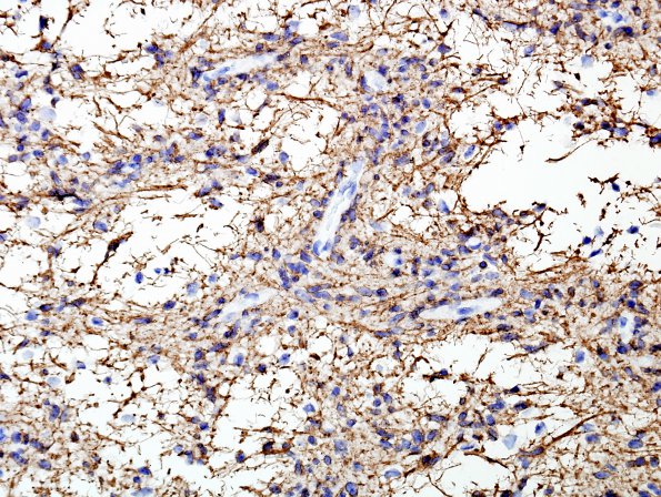 3B1 Angiocentric Glioma (Case 3) GFAP 3