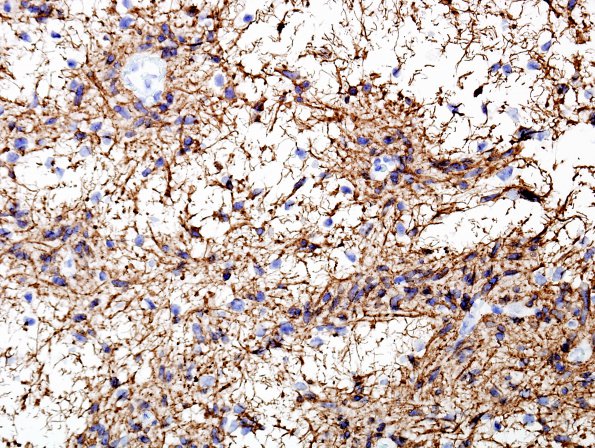 3B2 Angiocentric Glioma (Case 3) GFAP 1