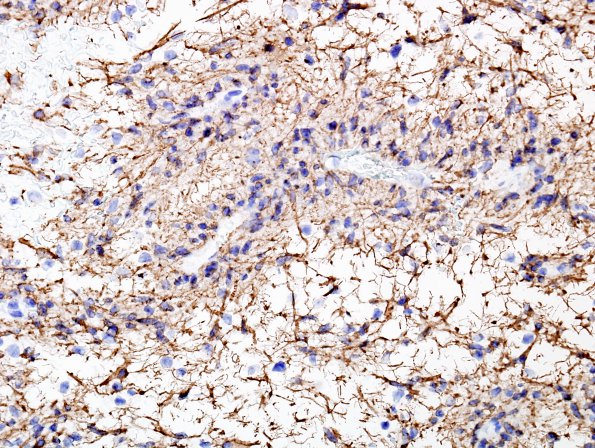 3B3 Angiocentric Glioma (Case 3) GFAP 2