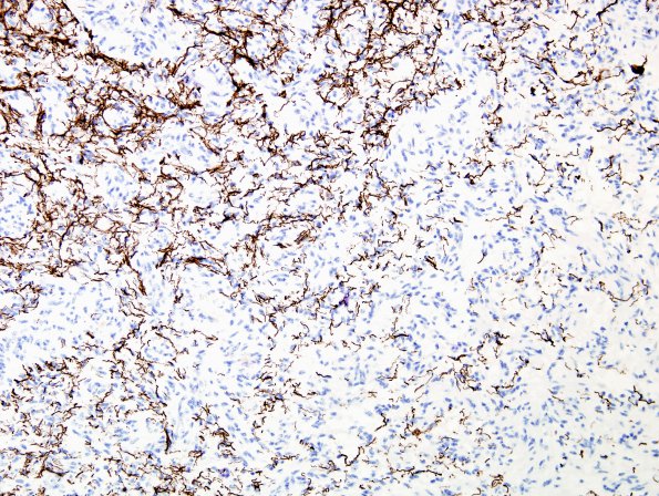 3C1 Angiocentric Glioma (Case 3) NF 2