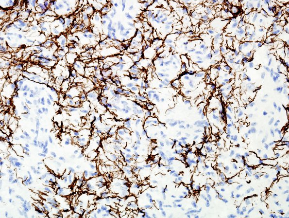 3C2 Angiocentric Glioma (Case 3) NF 1