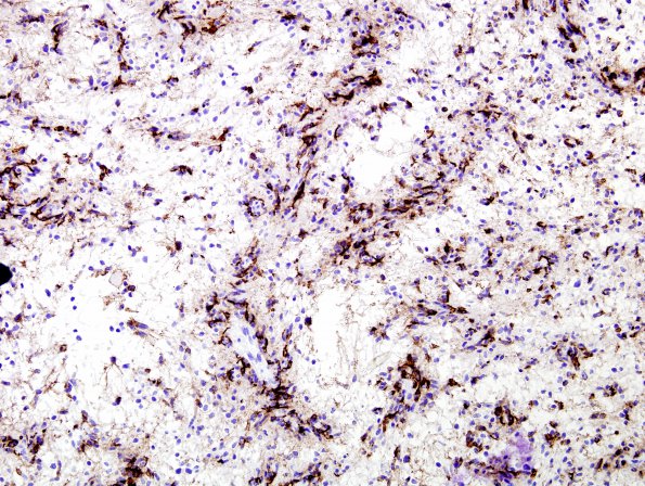 3D Angiocentric Glioma (Case 3) EMA 1